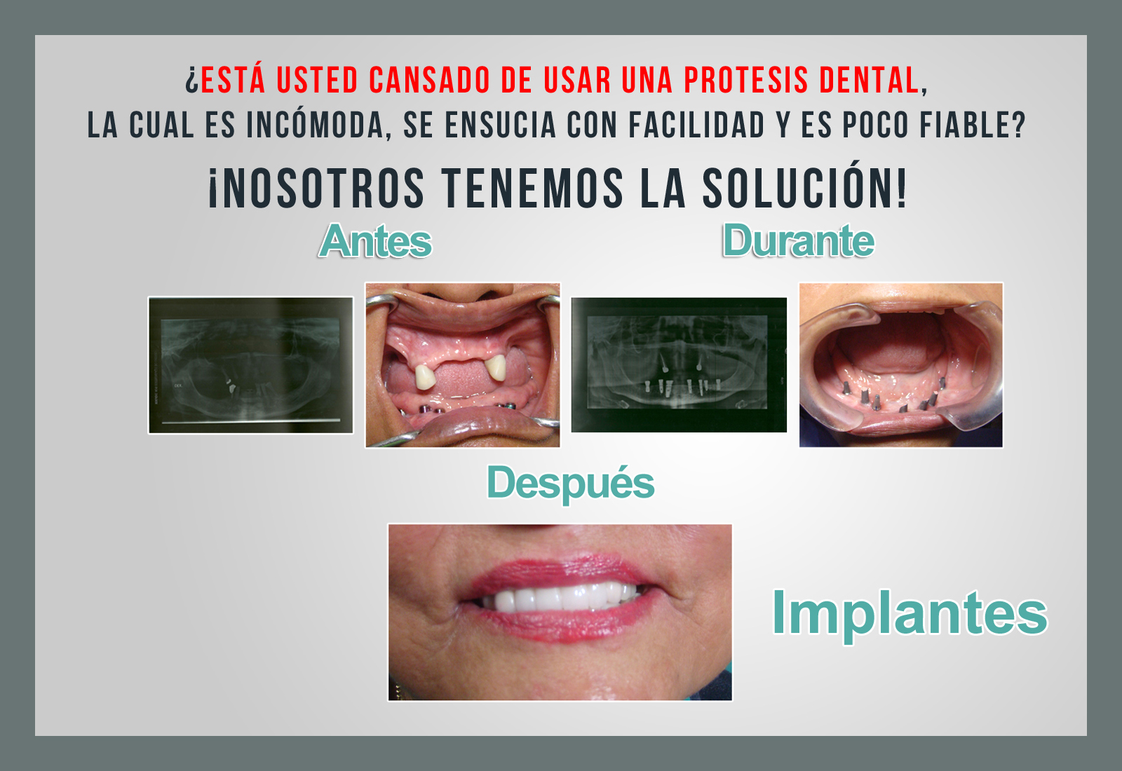 Implantes